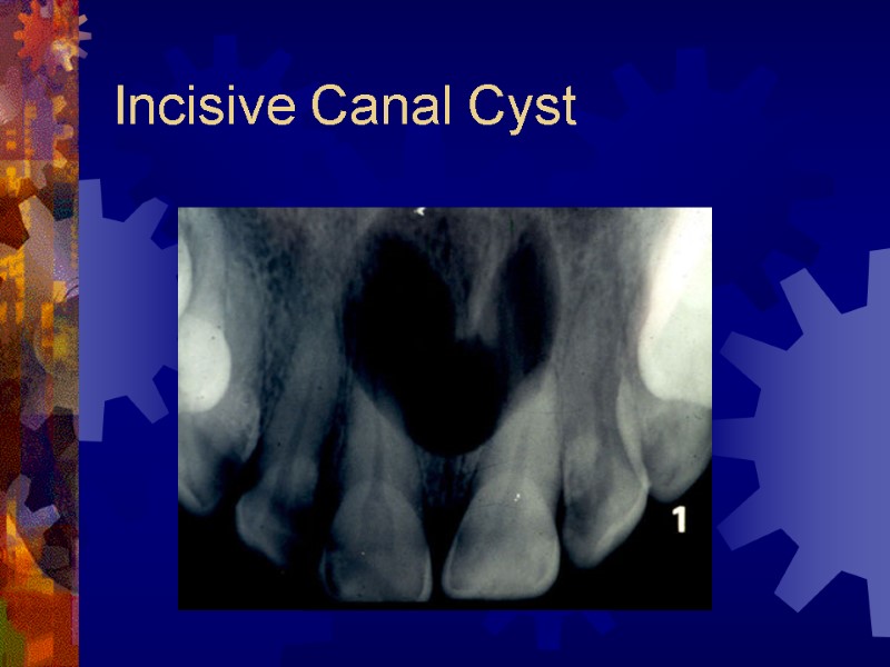 Incisive Canal Cyst